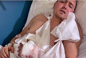 Poważny wypadek Jacka - trzeba uratować jego dłoń-25476