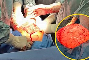 Ogromnej wielkości guz w brzuchu - płońscy lekarze ratują życie 20-latce-25915