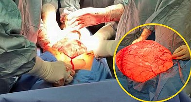 Ogromnej wielkości guz w brzuchu - płońscy lekarze ratują życie 20-latce-25915