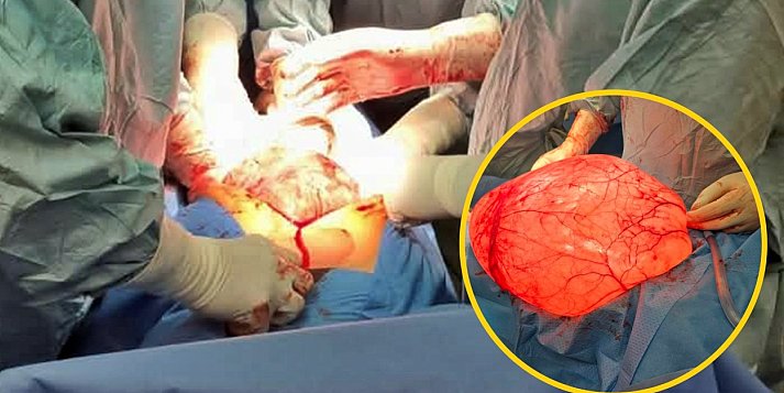 Ogromnej wielkości guz w brzuchu - płońscy lekarze ratują życie 20-latce