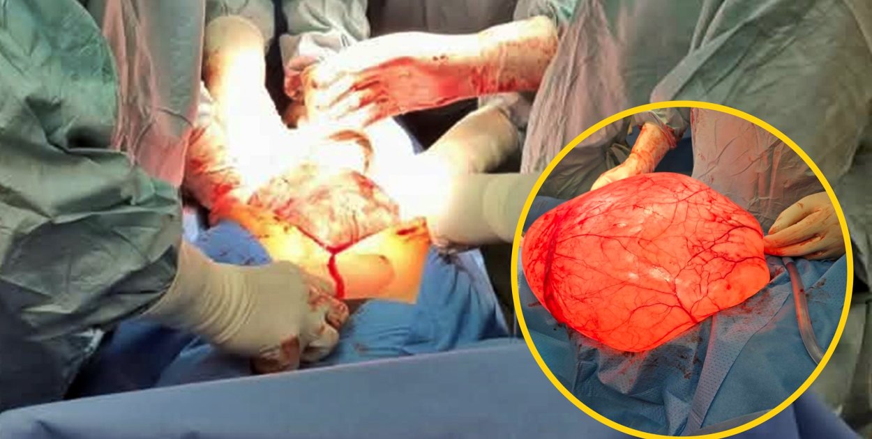 Guz miał ok. 48 centymetrów i ważył ok. 20 kilogramów [fot. zbiory szpitalne]